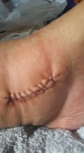 Cirurgia de artrose por sequela de acidente de Ana claudia  - Gratidão a quem puder ajudar 