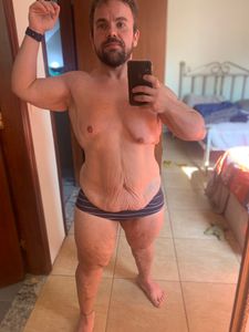 Vaquinha Online - Retirada de pele após emagrecimento 