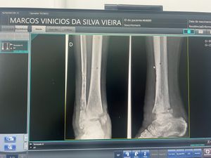 Vaquinha Online - Eu Marcos Vinicius peço a ajuda de vcs , pois estou desempregado com família e sem condições de trabalhar devido está em situação complicada após ter caído da laje a trabalho . 