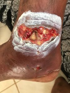 Nova Iguaçu/RJ - Eu Marcos Vinicius peço a ajuda de vcs , pois estou desempregado com família e sem condições de trabalhar devido está em situação complicada após ter caído da laje a trabalho . 