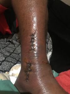 Eu Marcos Vinicius peço a ajuda de vcs , pois estou desempregado com família e sem condições de trabalhar devido está em situação complicada após ter caído da laje a trabalho .  imagem 6