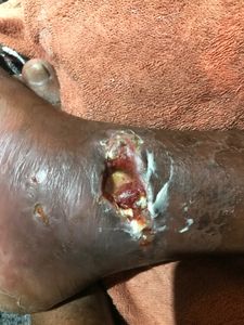 Marcos Vinicius - Eu Marcos Vinicius peço a ajuda de vcs , pois estou desempregado com família e sem condições de trabalhar devido está em situação complicada após ter caído da laje a trabalho . 