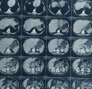 Vaquinha Online - Exames e extração dos nódulos 