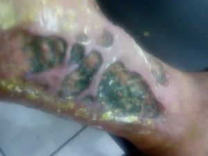 Vaquinha Online - Tratamento da úlcera