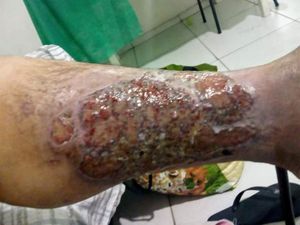 solange lopes - Tratamento da úlcera