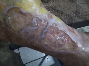 Caridade e Filantropia - Tratamento da úlcera