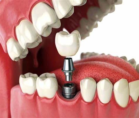 inplanter dentario 