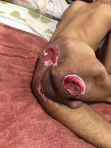 Whalison - Tenho úlcera de pressão a mais de 15 anos.só vivo deitado em uma cama.não aguento ficar 10 minutos sentado sem dor e soar..queria poder fazer essa cirurgia pra melhorar minha vida,queria poder andar na rua e comer na mesa um dia ..