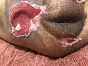 Saúde e Emergências - Tenho úlcera de pressão a mais de 15 anos.só vivo deitado em uma cama.não aguento ficar 10 minutos sentado sem dor e soar..queria poder fazer essa cirurgia pra melhorar minha vida,queria poder andar na rua e comer na mesa um dia ..