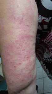 Vaquinha Online - Creme para auxiliar a pele de quem faz radioterapia ou tem psoríase