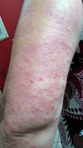 Empreendedorismo e Pequenos Negócios - Creme para auxiliar a pele de quem faz radioterapia ou tem psoríase