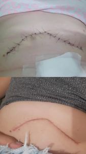 Ajude a dar continuidade no tratamento de Cynthia - Tratamento com Lutécio-177 Radioativo.