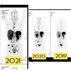 Saúde e Emergências - Tratamento com Lutécio-177 Radioativo.