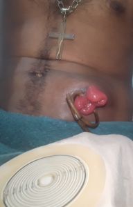 Vaquinha Online - Vaquinha para conseguir uma prótese mecânica 