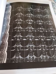 Daniele Andrade  -  Cirurgia de Mamoplastia Redutora 