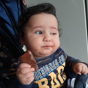 Cirurgia por risco de perder a visão, cirurgia plástica ocular - ptose palpebral congênita imagem 7