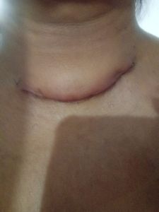 Vaquinha Online - Vamos ajudar Rosa no tratamento contra o câncer de Tireoide?