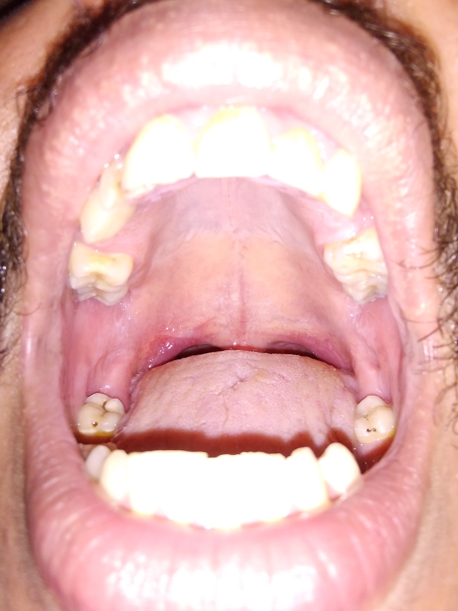 Arrumar Dentes - Restaurar Dentes