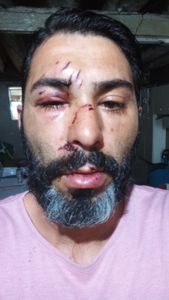 Ajuda para cirurgia nasal, pagar danos do carro e da casa onde o carro bateu