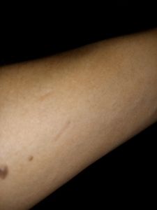 Exames de nódulos no seio