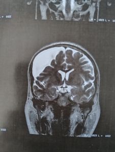 Tratamento cérebral 