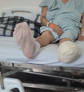 D. Madalena amputou metade do pé e está internada precisando de ajuda para custos de acompanhamento