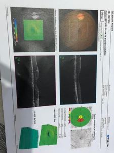 Operação descolamento da retina com urgência 