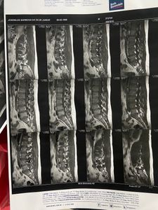 Cirurgia lombar urgente 