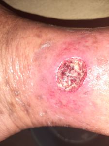 TRATAMENTO DE ALTO CUSTO