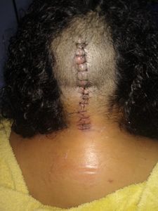 Cirurgia no crânio e pescoço-Síndrome de Arnold Chiari