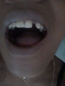 Implante para fatima