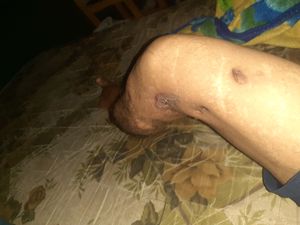 Campanha em prol ao roberson ajudar a conquistar o seu carro adaptado