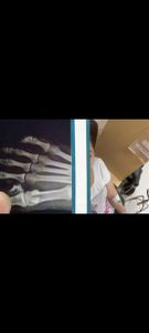 Ajuda para cirurgia e tratamento de tumor no pé 