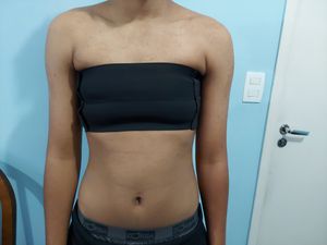 Cirurgia Mastectomia para homem transgênero