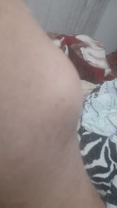 Cirugia  sisto em desenvolvimento 