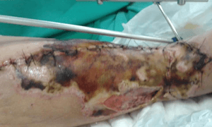 Cirurgia plástica da perna da minha mãe 