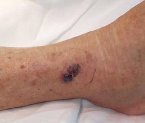 Peço a ajuda de vocês para o tratamento de câncer de pele. 