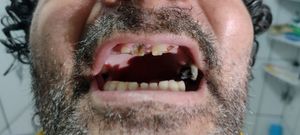 Comi meus próprios dentes 