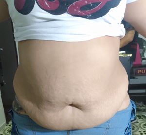 AJUDEM INGRID, CIRUGIA DE 7 HERNIAS MAIS ABDOMINO