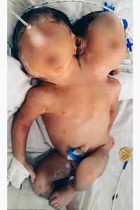 Menina siamesa precisa de cirurgia urgente nos  Estados Unidos 