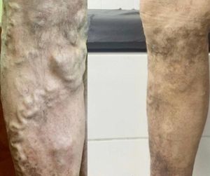 Cirurgia da perna do meu marido 