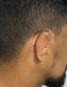 Tratamento e Cirurgia plástica da minha orelha 👂🏽🙏🏽