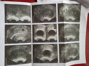 Ajuda para Biópsia de pólipos no endométrio.🙏