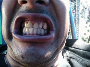 Tenho vergonha de sorrir, gostaria de fazer um implante, mas o custo é muito alto e não consigo custear com o valor de R$30.000,00