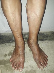 Ajuda para custear dois procedimentos cirúrgicos nas varizes e nos olhos da minha mãe 