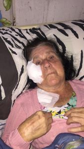 Cirurgia plástica para recuperação da face devido a retirada de tumor maligno