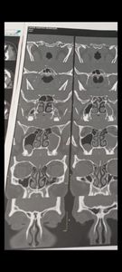 Lucas foi diagnosticado com tumor na cabeça, começou com pus na cabeça e agora virou um tumor maligno, que pode mata-lo a qualquer momento e precisa fazer essa cirurgia 