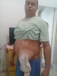 Ajuda para realizar minha cirurgia de reconstrução do trânsito intestinal 