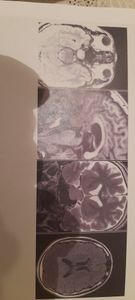 Arrecadando fundos para parte da cirurgia do Tumor