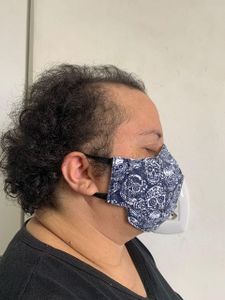 TRANSPLANTE CAPILAR DA JUNIA ALMEIDA